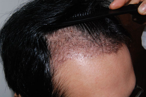 脂溢性脱发2级植发效果对比